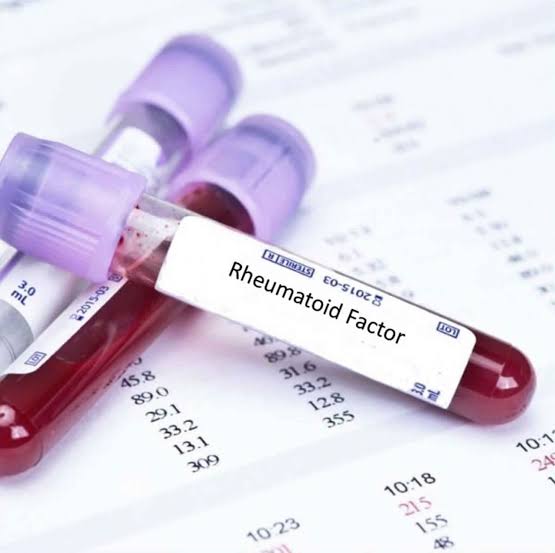 Rheumatoid Factor Test